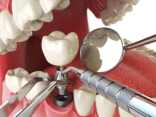 Best Urgent Care for Lost Fillings or Crowns in Geneva, WA